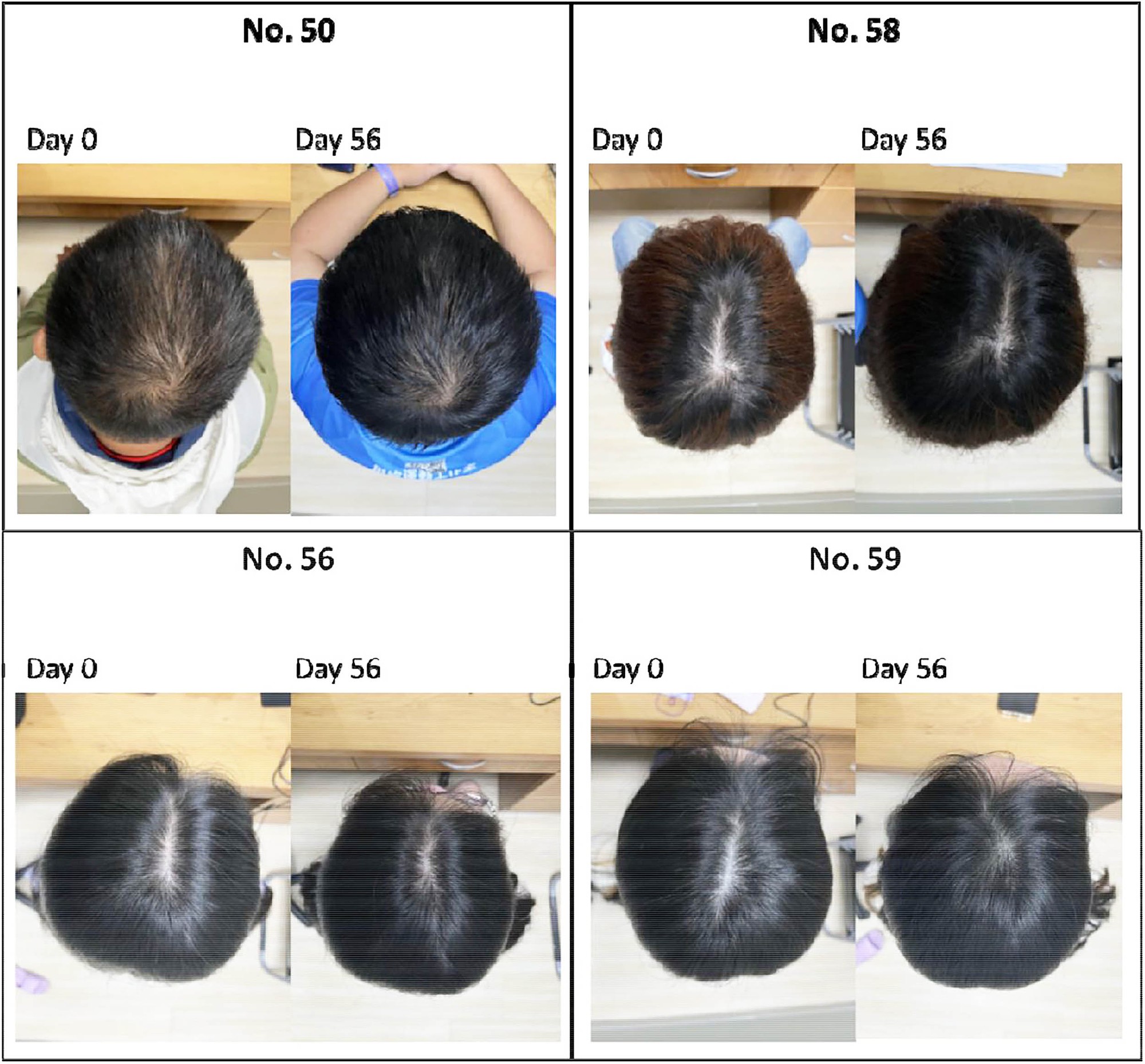 hair-growthtest-photosplant-formulamedrxiv1m-17767569094822060517131-1777006962172-1777006962558925475048 Bệnh hói đầu sắp ”tuyệt chủng” đến nơi: Huyết thanh từ thực vật giúp tóc dày lên 25% chỉ trong 56 ngày - Ảnh 1.